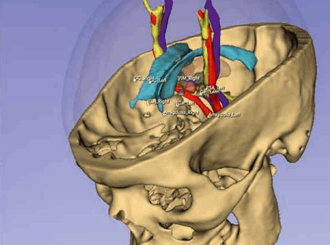 Молодые учёные СПбГУТ представили возможности протокола OpenIGTLink для нейрохирургов